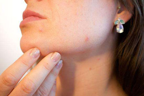 痘痘长在脸上的位置意味着什么