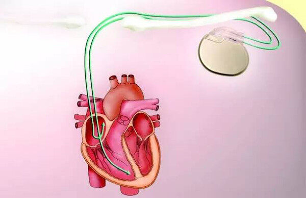 心脏起搏器如何使心脏恢复跳动的