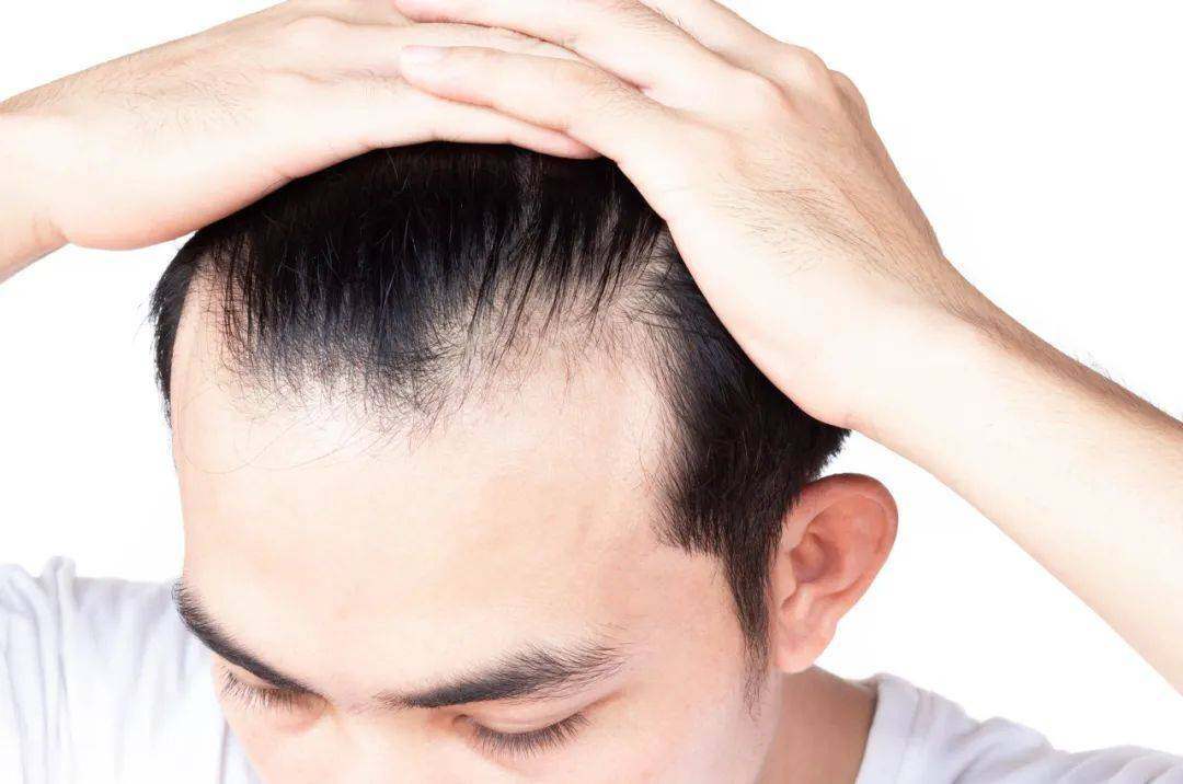 男性脱发是因为雄激素过多吗